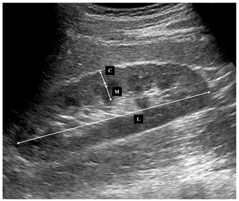 how to measure renal cortical thickness on ultrasound|cortical thinning of both kidneys.